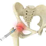 Hip Joint Injections